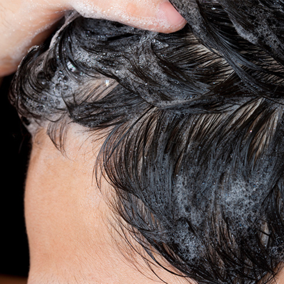 Can I remove persistent flakes without irritation?