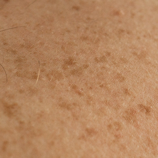 Dull uneven tone