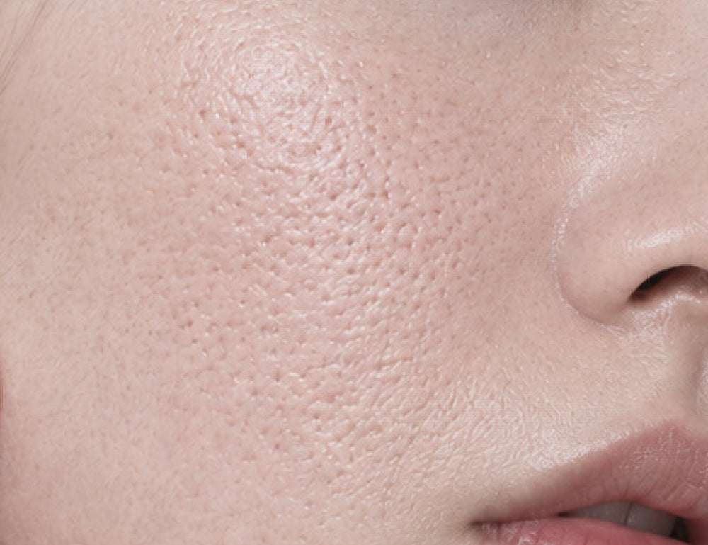 Enlarged Pores & Loss of Elasticity