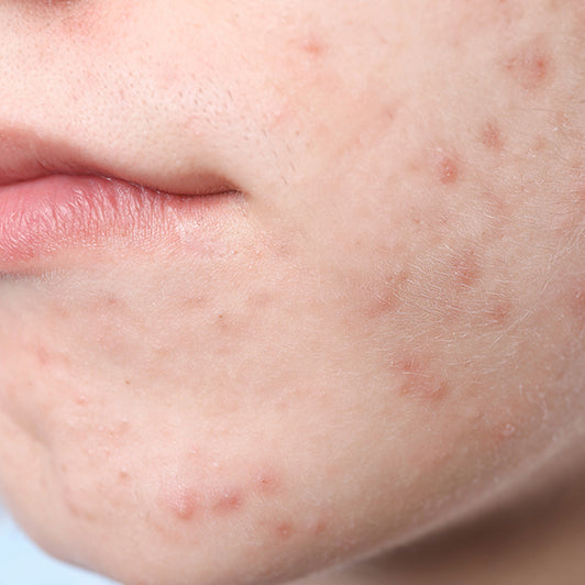 Shine and blemishes