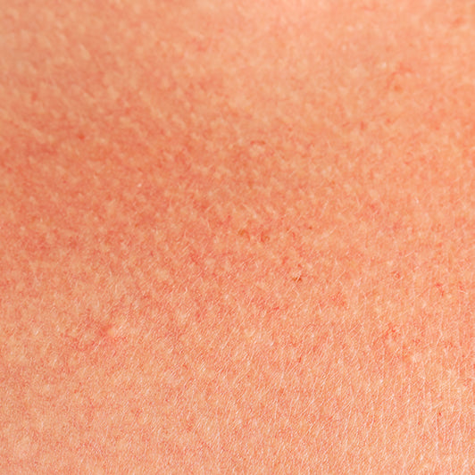 Sun-stressed redness